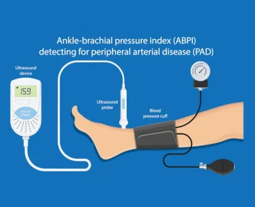 ankle brachial index test