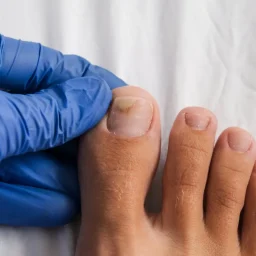 hydrogen peroxide for toenail fungus