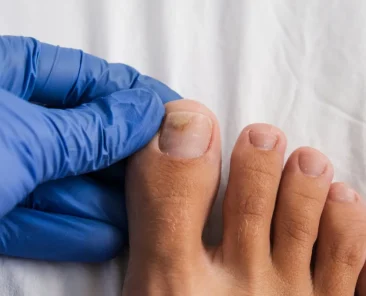 hydrogen peroxide for toenail fungus