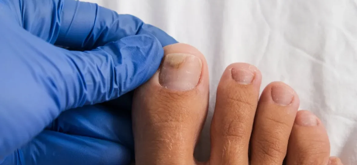 hydrogen peroxide for toenail fungus