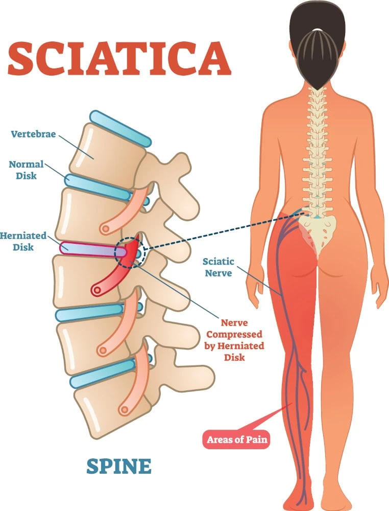 sciatic nerve pain infographic of nerves