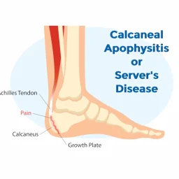 calcaneal apophysitis severs disease ankle injury broken bone