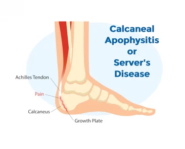 calcaneal apophysitis severs disease ankle injury broken bone