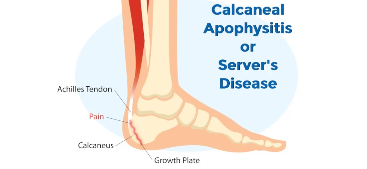 calcaneal apophysitis severs disease ankle injury broken bone