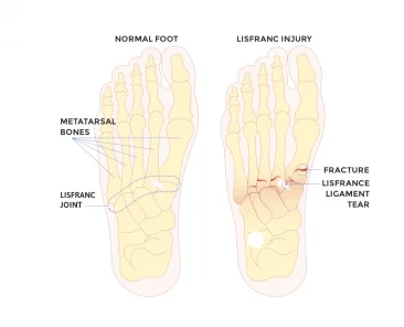 lisfranc injury fracture