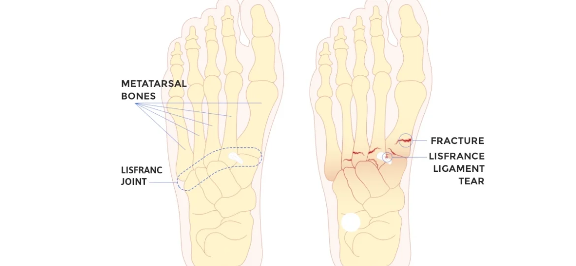 lisfranc injury fracture