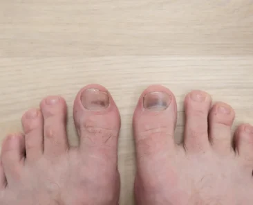 dark spot on toenail