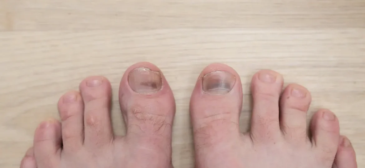 dark spot on toenail