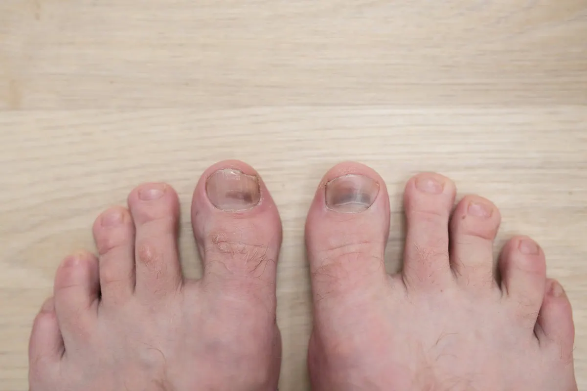 Dark Spot on Toenail? Causes, Treatments, and When to Worry