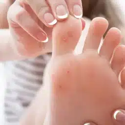 Plantar Wart on Your Toe