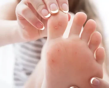 Plantar Wart on Your Toe