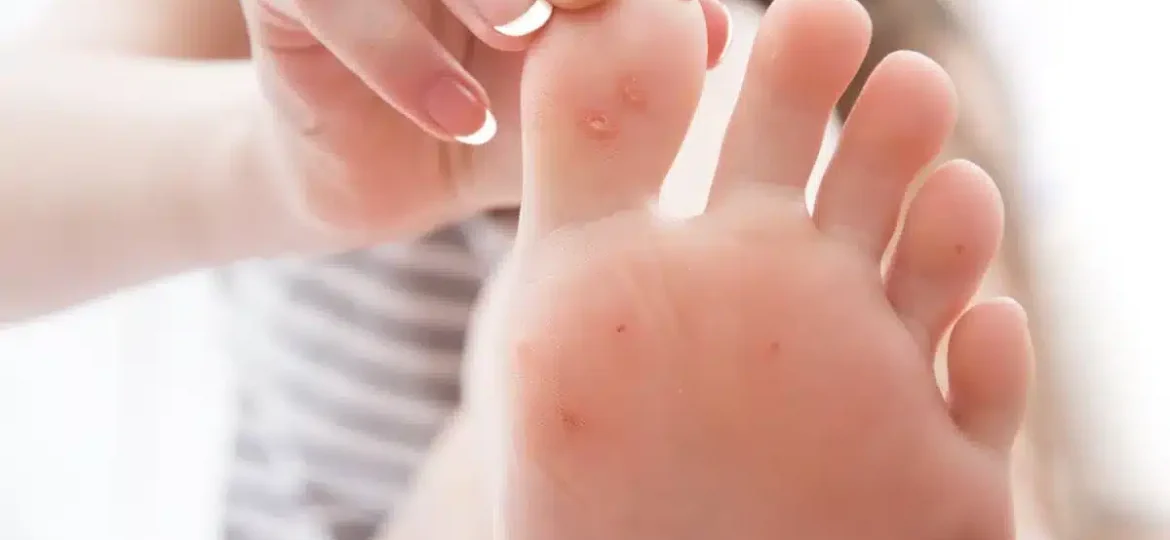 Plantar Wart on Your Toe