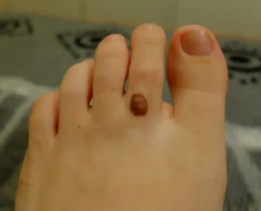 melanoma on foot