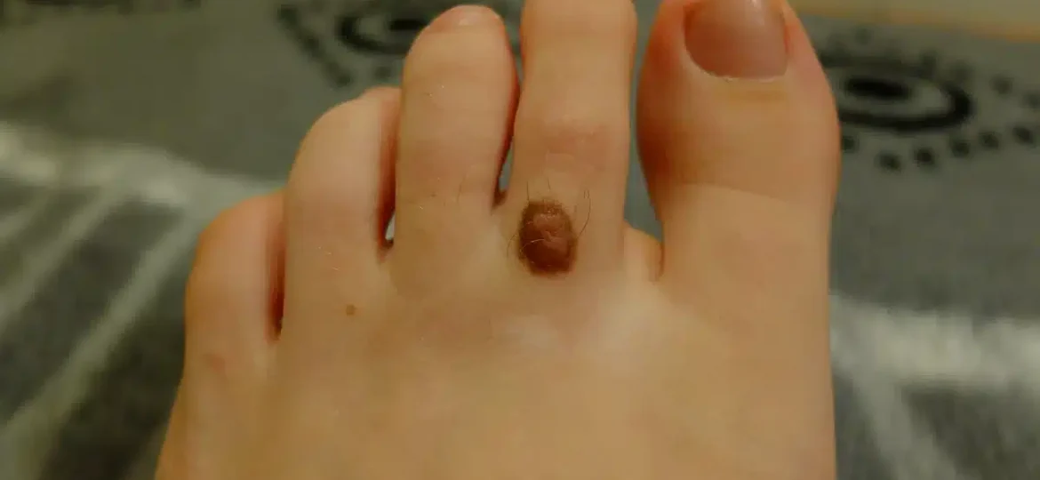 melanoma on foot