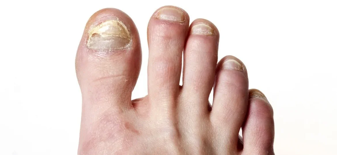 what kills toenail fungus instantly