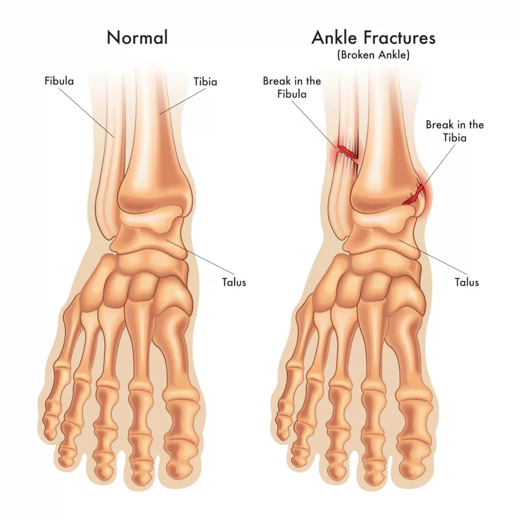 Ankle Fractures