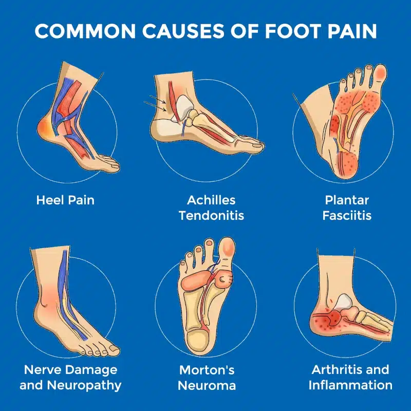 Common Causes of Sudden Foot Pain Without Injury
