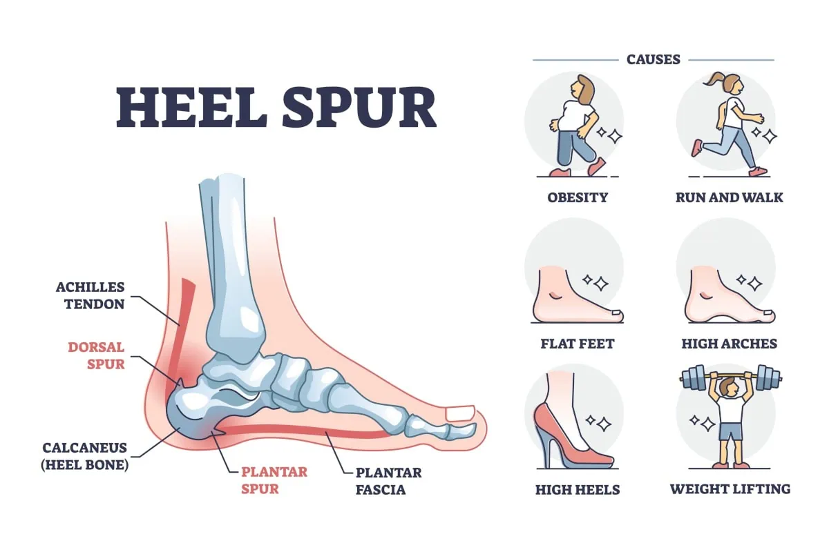 Heel spur surgery The causes of Heel Spur Infographic