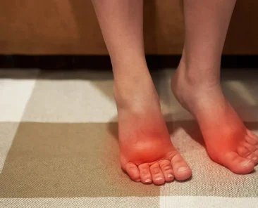 how-to-reduce-feet-swelling-cfas