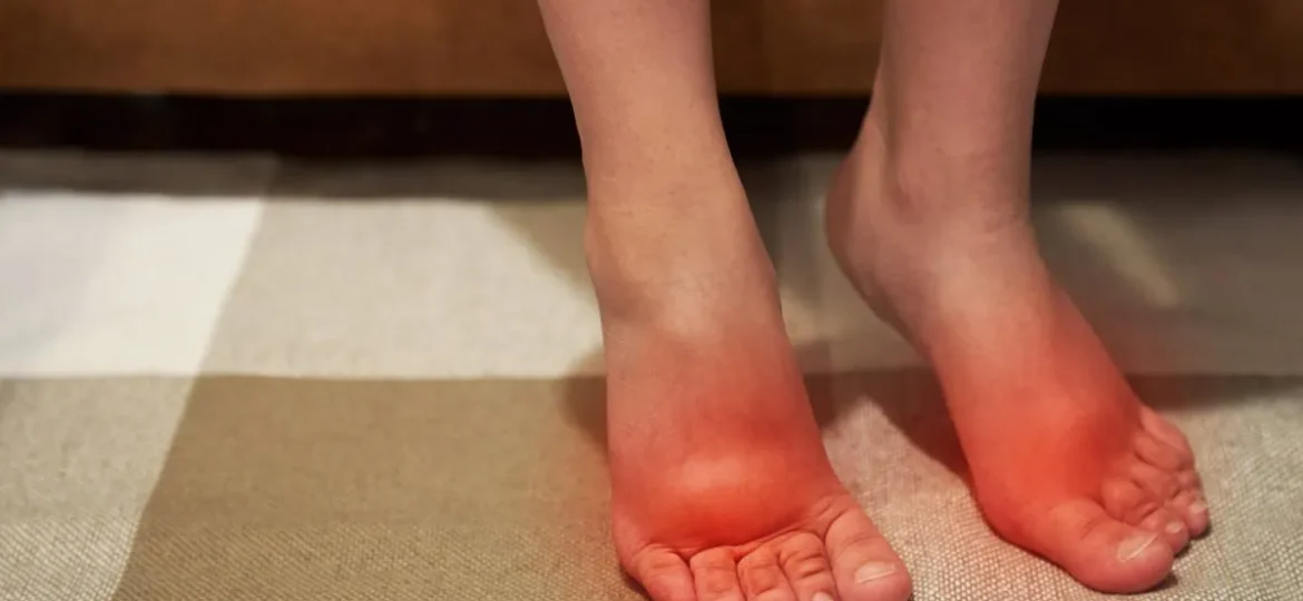 how-to-reduce-feet-swelling-cfas