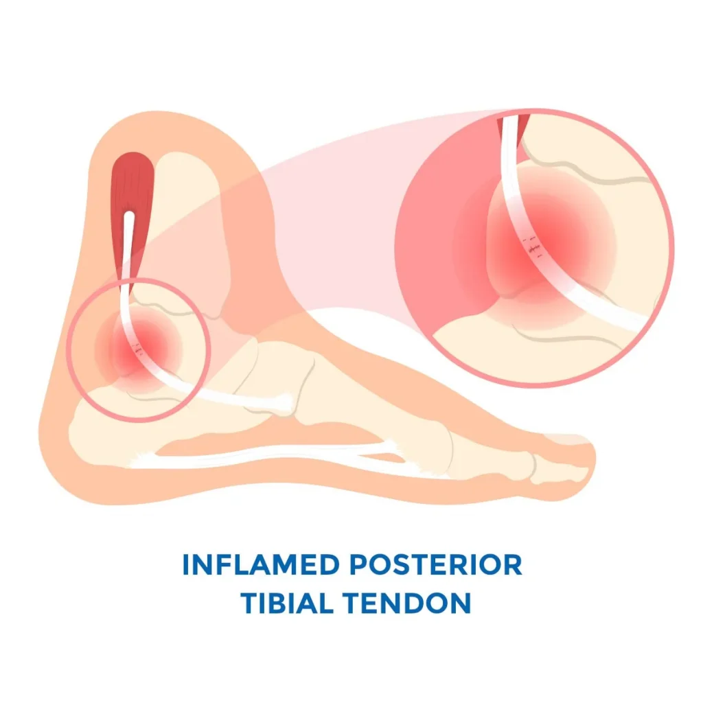inner ankle pain inflamed posterior tibial tendon infographic
