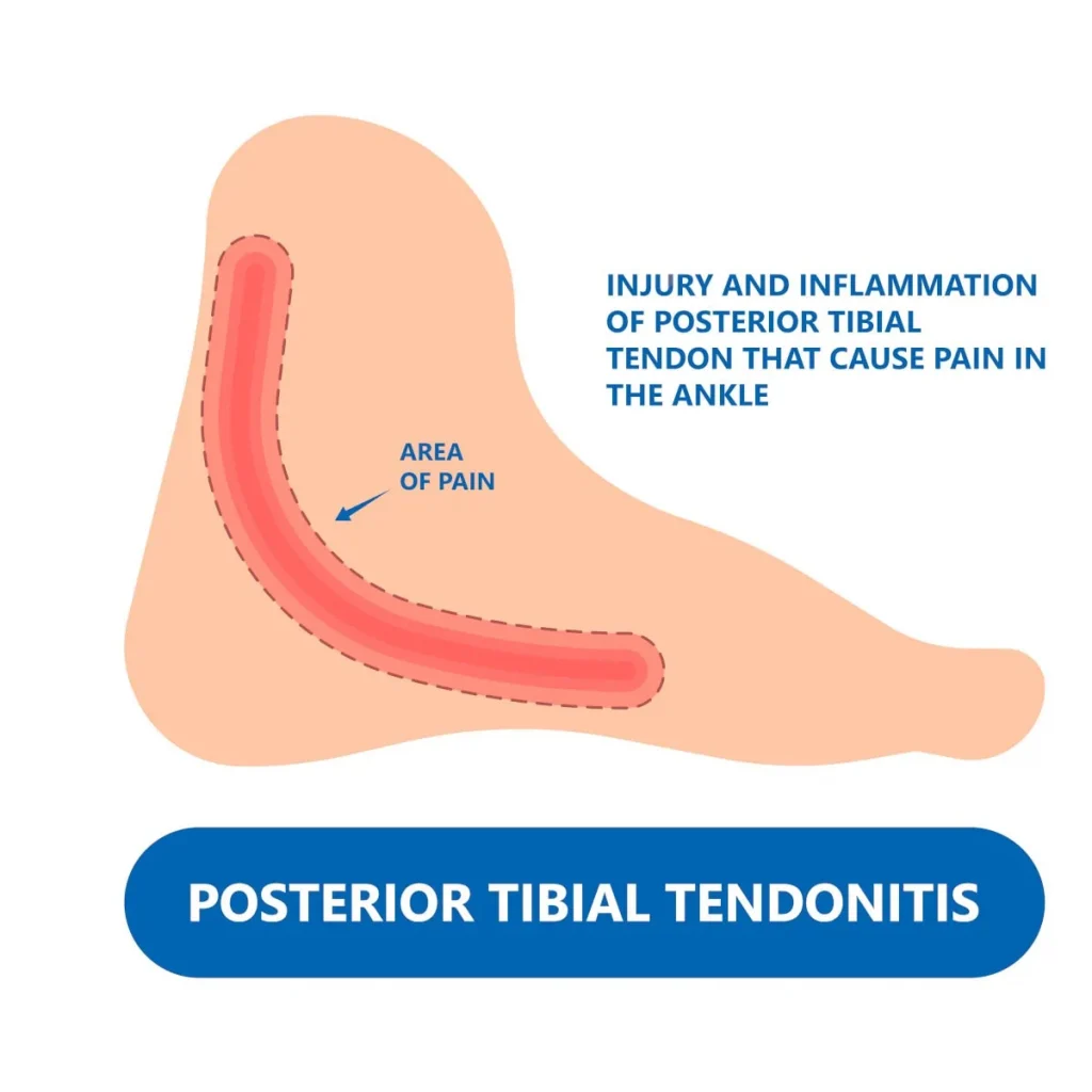 inner ankle pain posterior tibial tendonitis