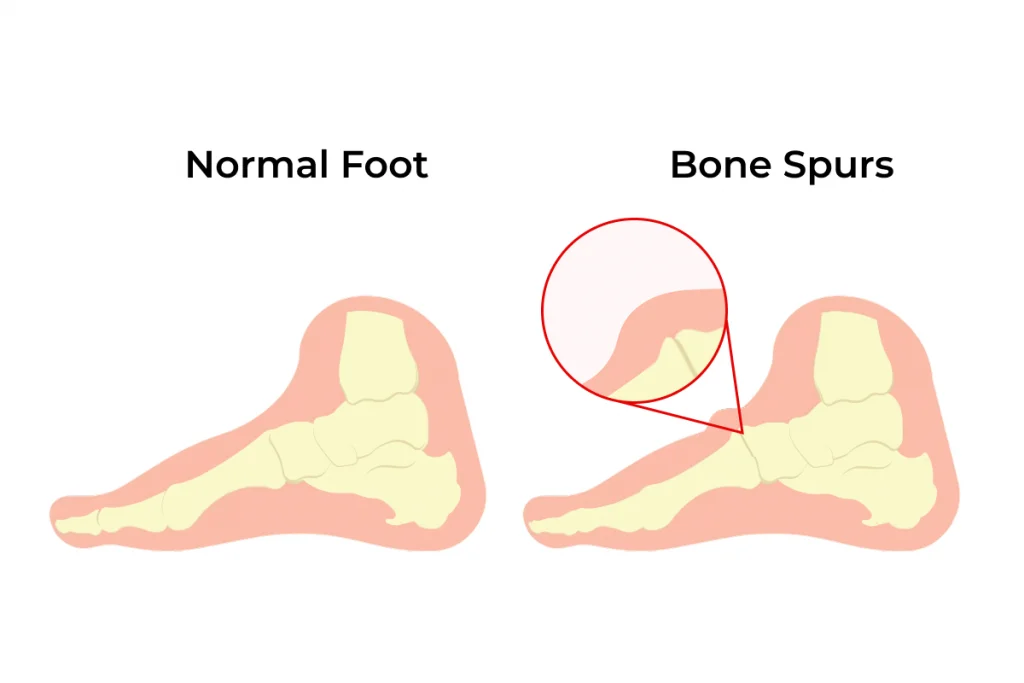 bone spur on top of foot infographic skeleton