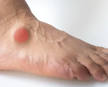 bone spur on top of foot
