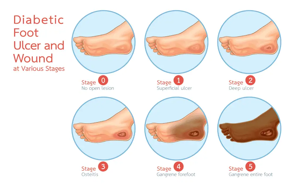 diabetic foot injection stages of ulcers and wounds