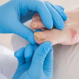 best over the counter toenail fungus removal