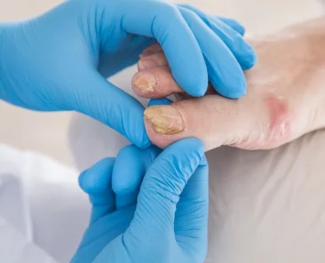 best over the counter toenail fungus removal