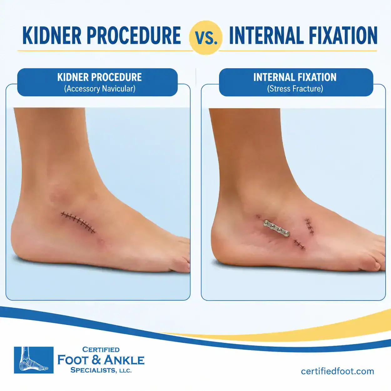 Kindner Procedure vs Internal Fixation