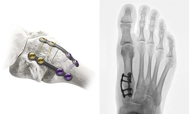 titanium brace lapipplasty 3d bunion correction