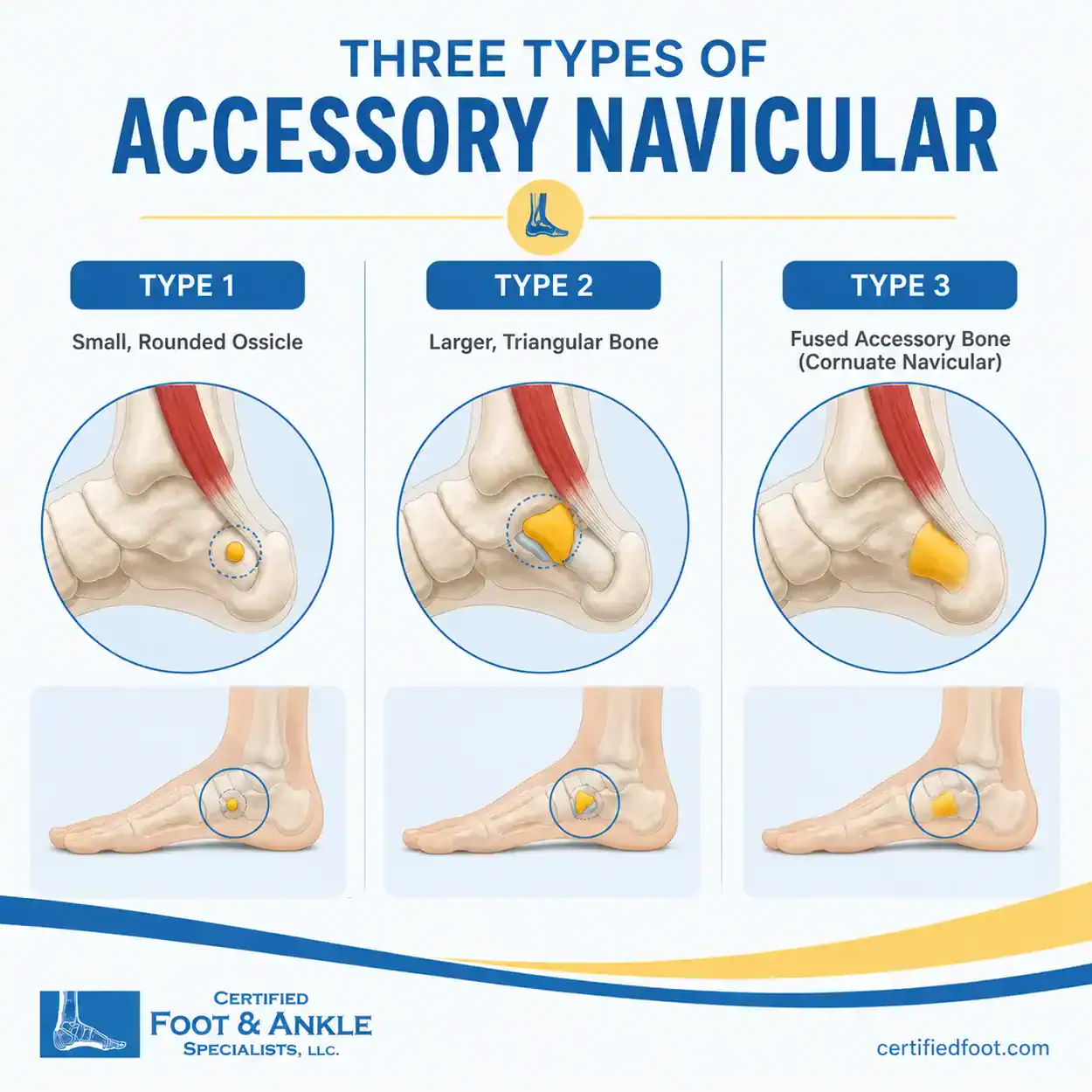 Three Types of Accessory Navicular