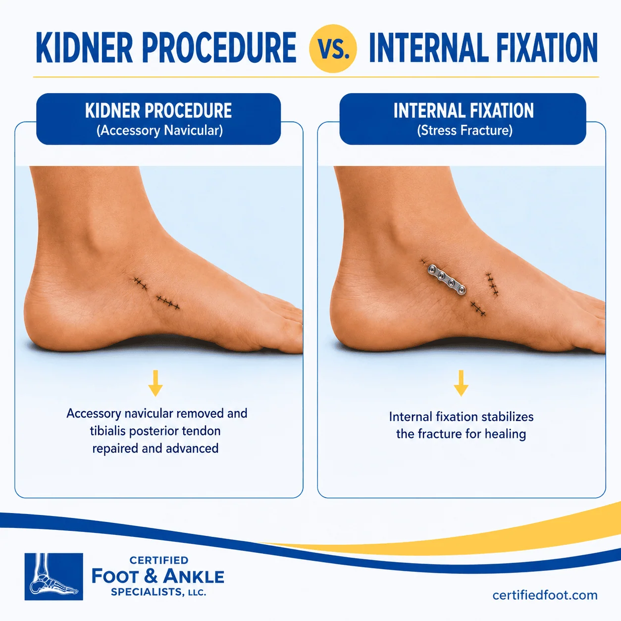 Kindner Procedure vs Internal Fixation Kindner Procedure vs Internal Fixation