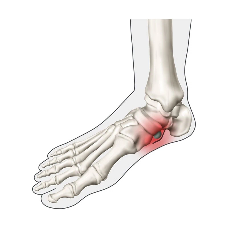skeleton-accessory-navicular-bone kidner procedure accessory navicular bone foot skeleton area