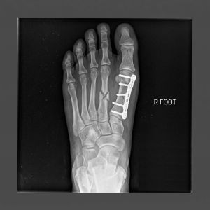 Open reduction internal fixation Open reduction internal fixation