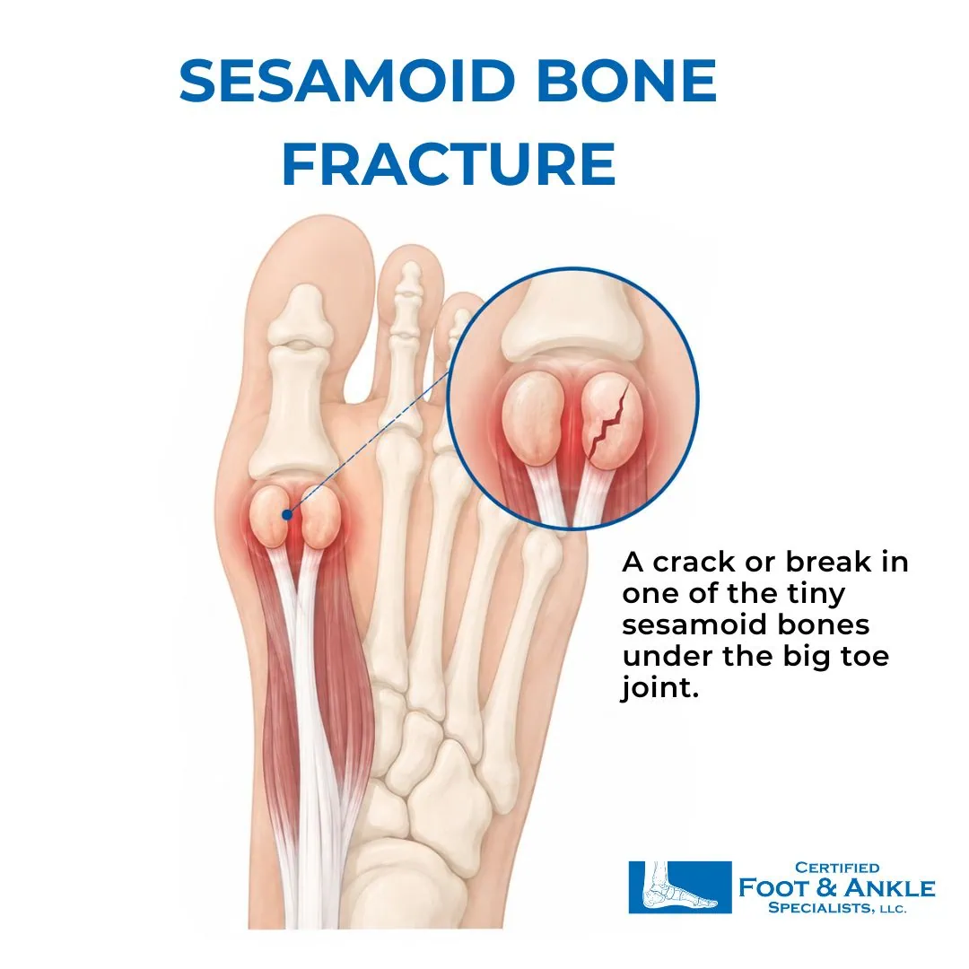 sesamoid bones fracture infographic sesamoid bones fracture infographic